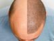 hair implant